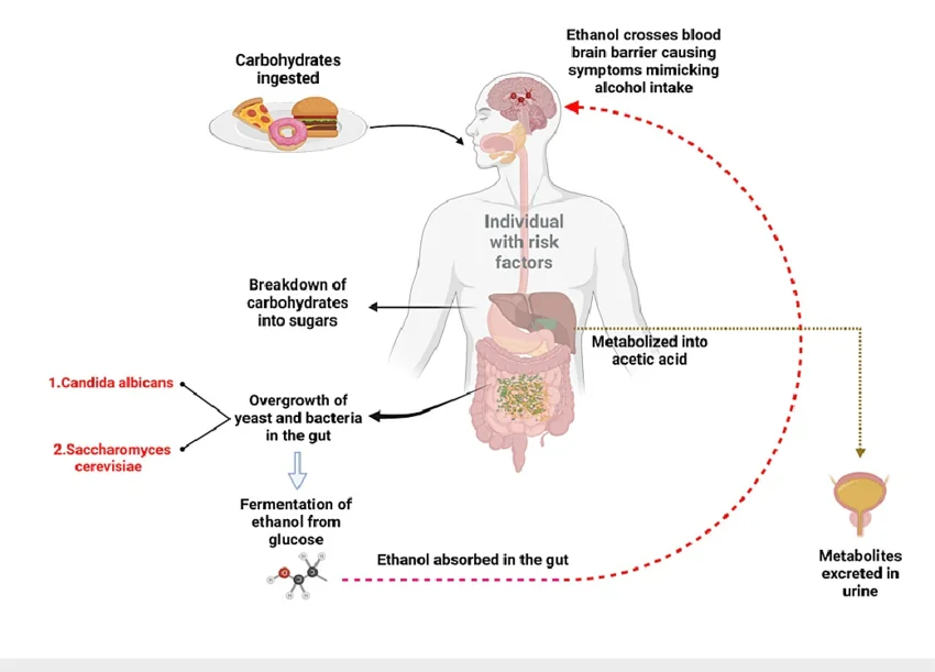 Auto Brewery Syndrome