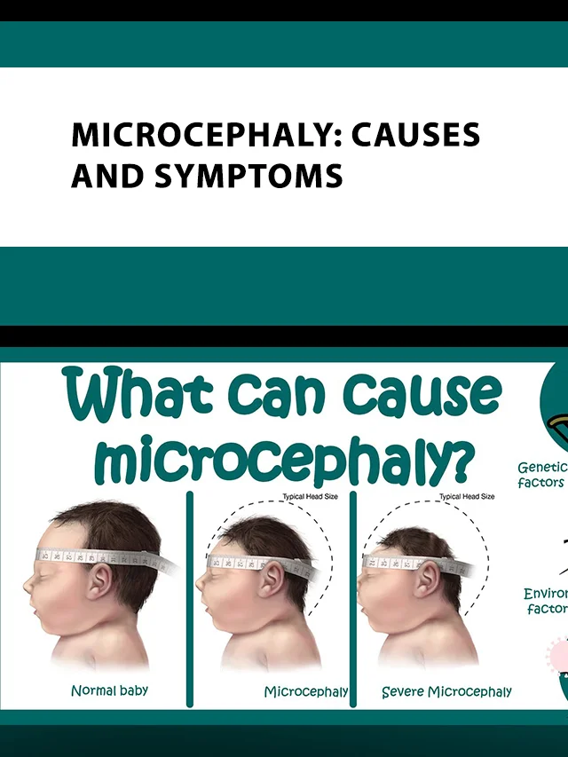 Microcephaly causes and symptoms poster