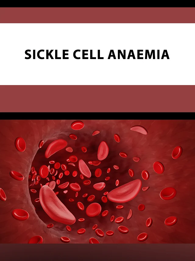 Sickle Cell Anaemia poster