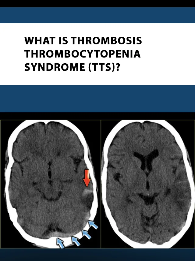 What is Thrombosis Thrombocytopenia Syndrome (TTS) poster