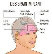 Deep Brain Stimulation Device