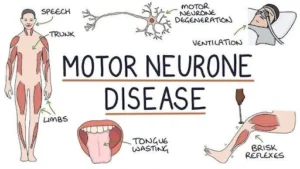 Motor Neuron Diseases (MNDs)