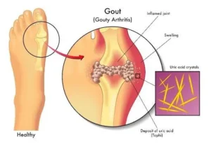 Gout