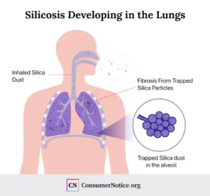 Silicosis