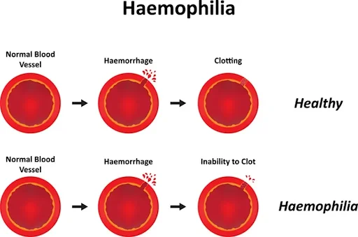 Haemophilia A