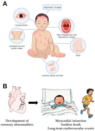 Kawasaki Disease